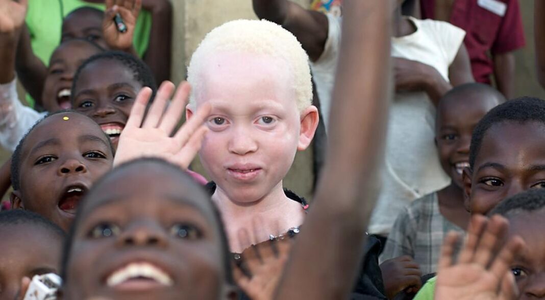 Ser albino: En África puede llevar a la muerte, en Europa y América, una estrella de la moda